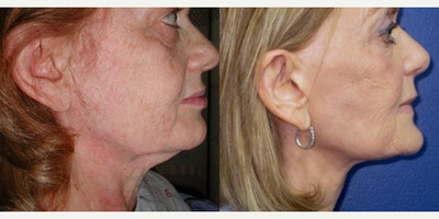 Titan - Woman treated with Titan