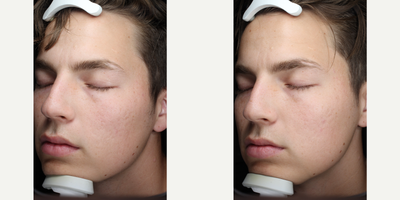 18-24 year old man treated with Intracel - Patient had 3 treatments of Intracel.