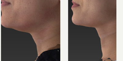 35-44 year old woman treated with Age Spots Treatment - Skin tightening done by our unique Tyte & Bryte procedure.