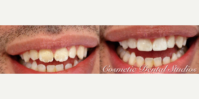 Man treated with Dental Bonding - Man Makeover Monday is this guy who wanted to improve his smile. DrV performed a little bonding and recontouring. Finished him off with whitening. There was No tooth structure taken away. Just one visit for his new confident smile.