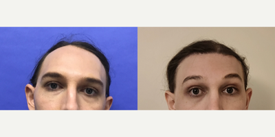Patinet treated with Forehead Reduction, Brow Lift, Hair Transplant - Removal of Tissue Expander, Forehead Lift, Hairline Loweri - 25 to 34 year-old female patient is 1 year 3 months post-op from Removal Tissue Expander - Forehead Lift, Hairline Lowering, Orbital Bony Contouring, and 300 Micrografts to Recessions. 25 to 34 year-old female patient is 1 year and 6 months post-op from Facial Feminization surgery. Her procedures included: Placement of Tissue Expander - Frontal, Septorhinoplasty (closed) with Cartilage Grafts, Cheek Implants (small), Chin Reduction and Contour, Intranasal Lip Lift with Fat Augmentation, and Thyroid Cartilage Shave.