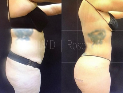 Woman treated with Brazilian Butt Lift - This amazing patient is now about a year out from an amazing BBL.