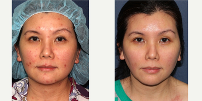 25-34 year old woman treated with ResurFX - Woman with chicken pox scars on the face is the treated with Lumenis ResurFX laser. Amazing improvement in the appearance of scars after only 9 months.