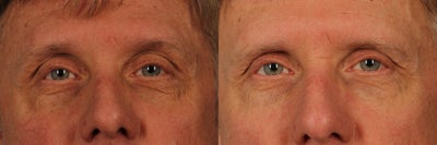 58 year old man treated with Infini RF to lower lids - Picture taken 2 months after three infini treatments to lower lids