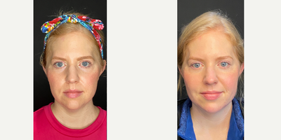 35-44 year old woman treated with Collagen Injection, Restylane Lyft, Dermal Fillers - This client had 3 syringes of Restylane Lyft to cheeks, chin and jawline as well as 2 vials of Sculptra.