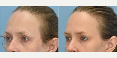 Woman treated with Botox - Woman treated with Botox.