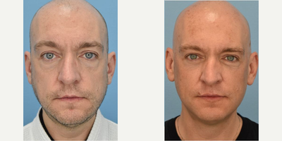 Man treated with Botox - Man treated with Botox.
