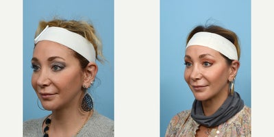 35-44 year old woman treated with Earfold - otoplasty