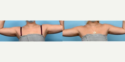 25-34 year old woman treated with Cryolipolysis - CoolSculpting for the arms