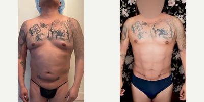 Man treated with Vaser Liposuction, Power-Assisted Liposuction (PAL), Renuvion - Man treated with Vaser Liposuction, Power-Assisted Liposuction (PAL), Renuvion