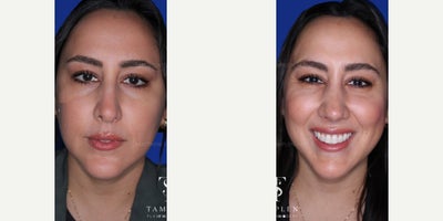 Woman treated with Revision Rhinoplasty - Woman treated with Revision Rhinoplasty
