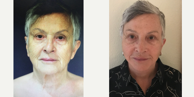 75 and up year old woman treated with Facelift - 78 year old woman treated with The Angle Lift (facelift)