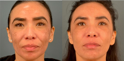 35-44 year old woman treated with Venus Viva - fractional laser/RF for the treatment of melasma/post inflammatory hyperpigmentation.