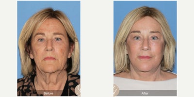 68 year old woman treated with Deep Plane Facelift, Neck Lift, Brow Lift, CO2 Laser, MACS Facelift - 68 year old woman treated with Deep Plane Face and Neck Lift, Temporal Brow Lift, CO2 Laser of Face, MAC