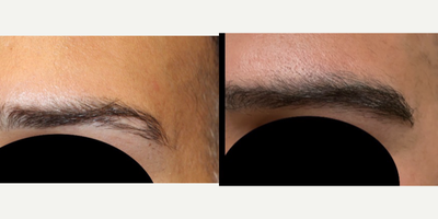 35-44 year old man treated with Eyebrow Transplant - 40 year old male 1 year post Eyebrow transplant for a scar revision via FUE method