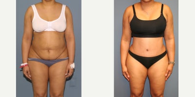45-54 year old woman treated with Tummy Tuck - Full tummy tuck muscle repair flank liposuction