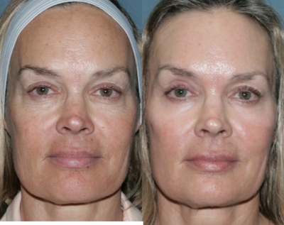Fraxel Repair Laser Treatment - 
	57 year old female wants to improve wrinkles below and around eyes, remove age spots, and improve texture.

	Note significant improvement in wrinkles around eyes, tightening of eyelids, and improvement in age spots with treatment with the Fraxel repair over the face and treatment of individual brown spots with the q-switched alexandrite (Fraxel repair and alex done at the same time).

