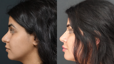18-24 year old woman treated with Rhinoplasty - 3 Months Post-operative