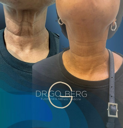 Woman treated with Nonsurgical Neck Lift - Woman treated with Nonsurgical Neck Lift