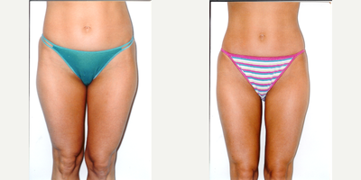 25-34 year old woman treated with Liposuction - Liposuction inner/outer thighs, knees, abdomen and flanks