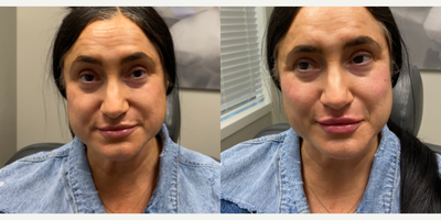 45-54 year old woman treated with Restylane Kysse - This 52-year-old patient turned to Dr. Wise for lip rejuvenation with Restylane Kysse filler. along with cheek contouring. After photos taken immediately after injection.
