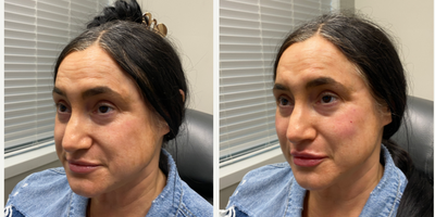 45-54 year old woman treated with Restylane Kysse - This 52-year-old patient turned to Dr. Wise for lip rejuvenation with Restylane Kysse filler. along with cheek contouring. After photos taken immediately after injection.