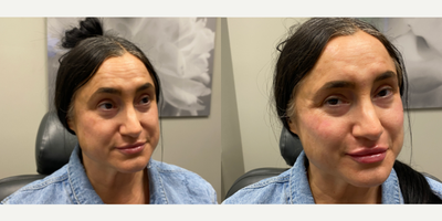 45-54 year old woman treated with Restylane Kysse - This 52-year-old patient turned to Dr. Wise for lip rejuvenation with Restylane Kysse filler. along with cheek contouring. After photos taken immediately after injection.