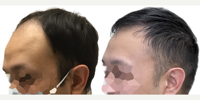 29 year old man treated with FUE Hair Transplant, Minoxidil and Finasteride - This is a gentleman who came to us at only age 29 for a hair transplant. His hair loss began in his early 20s and in only a few short years progressed to at least a Norwood Stage 5, or maybe beyond. He had never tried any evidence-based treatments to slow or reverse his hair loss. Despite his young age, he had complete obliteration of his hairline and front scalp, with near complete loss in the midscalp through to the crown. The result was disproportionate features, the loss of the frame to his face, and the appearance of being much older than his 29 years. Fortunately, he had an excellent donor area. Prior to surgery, we discussed the importance of supplementary non-surgical therapies like finasteride and minoxidil to help him preserve the hair he still had. In this way, we could use a hair transplant to replace what hes lost, knowing that hed be highly unlikely to lose additional hair in other areas. As a result of his large and dense donor area, we were able to perform a 3146 graft FUE surgery. This is one of the largest single session FUE surgeries ever performed at Toronto Hair Transplant Centre and is a larger graft amount for this type of surgery than average. You can see from our surgical drawings that his goal was not to achieve an overly aggressive hairline, but rather to have a natural hairline that preserved enough donor grafts to add some density in the midscalp and crown, while still giving him a frame to his face and good coverage upfront. He wanted the kind of hairline that would continue to look natural into his 30s, 40s, 50s and beyond. The majority of the grafts were distributed to the frontal scalp to rebuild the density there, while a few were added to the midscalp and crown. We knew this would not add overly thick density to those areas, but it would still make a significant difference. This patient returned to see us 13 months after his surgery. His results are absolutely amazing! He looks like, well, just a guy with hair! His forehead is much less prominent and he looks much more youthful and in line with his age. You can see in the detailed photo of his hairline that it looks completely natural and no one could ever tell hes had a hair transplant. His donor area continues to look dense without any noticeable evidence of even a large FUE harvest. He continues to use finasteride and minoxidil regularly, without any problems, and hasnt lost any additional hair. He looks great!