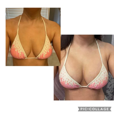 2 days post op - 34B should end up being a 34D. - Review - RealSelf