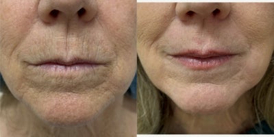 65-74 year old woman treated with Laser Peel - Peri-Oral TRL laser peel.