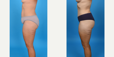 35-44 year old woman treated with Abdominal Etching, Diastasis Recti Repair, Drainless Tummy Tuck, Liposculpture, Liposuction, M - Before and after tummy tuck with lipo 360. This patient had a tummy tuck as part of her mommy makeover. She has excess skin and fat primarily below her belly button and in her suprapubic area. I did a low bikini incision removing all skin and fat from her belly button to her pubic area. I did a corset muscle plication of her stretched abdominal muscles. I did VASER ultrasound liposuction of her abdomen, flanks to shape her waist.