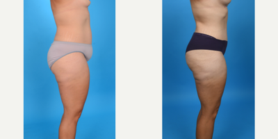 35-44 year old woman treated with Abdominal Etching, Diastasis Recti Repair, Drainless Tummy Tuck, Liposculpture, Liposuction, M - Before and after tummy tuck with lipo 360. This patient had a tummy tuck as part of her mommy makeover. She has excess skin and fat primarily below her belly button and in her suprapubic area. I did a low bikini incision removing all skin and fat from her belly button to her pubic area. I did a corset muscle plication of her stretched abdominal muscles. I did VASER ultrasound liposuction of her abdomen, flanks to shape her waist.