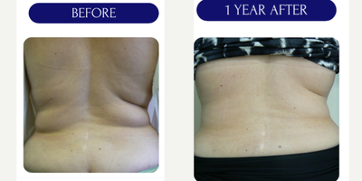 35-44 year old woman treated with Lipodissolve - lipodissolve injections