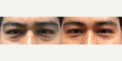 25-34 year old man treated with Injectable Fillers - Restylane injection under the eyes to treat eye bags on this young man.