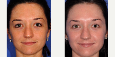 18-24 year old woman treated with Retin-A - Used Obagi with Retin-A to remove early sundamage
