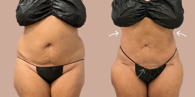 35-44 year old woman treated with AirSculpt - The patient received stomach airsculpt fat removal along with a tiny tuck, which is a smaller variation compared to a full tummy tuck. Procedure was done in Raleigh location and results are 3 months Post-Op.