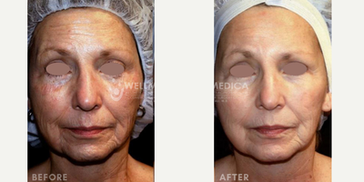 65-74 year old woman treated with Venus Viva - 3 month results after 3 Viva MD treatments on Face