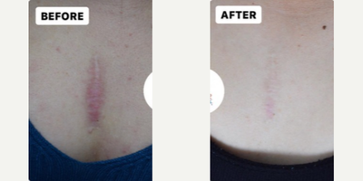 Woman treated with Laser Scar Removal - Woman treated with Laser Scar Removal, Vbeam