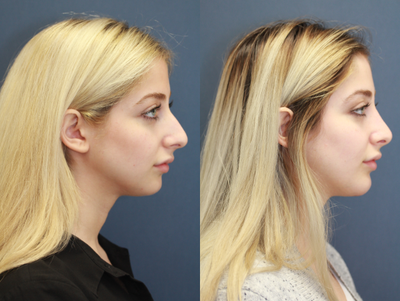 18-24 year old woman treated with Chin Implant - Chin Implant + Rhinoplasty