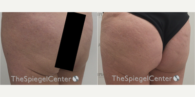 55-64 year old woman treated with Nonsurgical Butt Lift - 55-64 year old woman treated with Nonsurgical Butt Lift