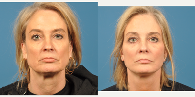 45-54 year old woman treated with SMAS Facelift - Face lift and lower lid blepharoplasty and facial fat grafting.
