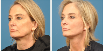 35-44 year old woman treated with SMAS Facelift - Facelift with lower Blepharoplasty and facial fat grafting