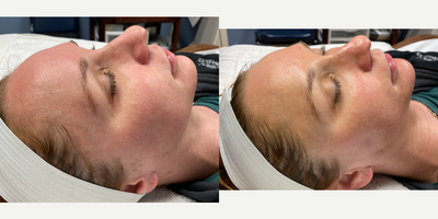 25-34 year old woman treated with DiamondGlow - Before and after of one Diamond Glow treatment using the Vitamin C serum.