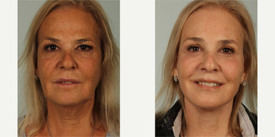 55-64 year old woman treated with Facelift - Patient had facelift, browlift and eyelid surgery. She is 6 weeks post operative. The incisions will continue to fade.