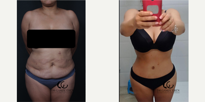 35-44 year old woman treated with Tummy Tuck, Lipo 360 BBL - The patient had undergone liposuction around abdomen, belly and back. Fat transfer is done to augment buttocks.Tummy tuck is done to remove excess skin.