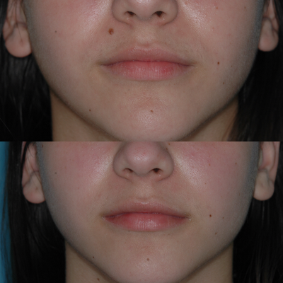 17 or under year old woman treated with Mole Removal - Mole removed with scar less technique.
