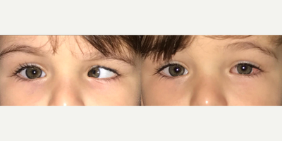 Kid treated with Strabismus surgery - Strabismus is a problem that can be corrected at all ages and should be handled with care in children. Pre and post-op photos of a 2-year-old patient on the 1st week after surgery.