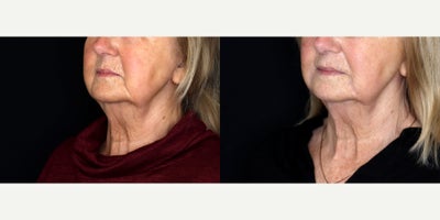 73 year old woman treated with Juvederm, Restylane - 73 year old woman treated with 2 syringes of Juvederm Ultra Plus XC To Nasal Labial Folds and 1 syringe of Restylane to perioral.