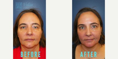 Woman treated with CO2 Laser, Laser Resurfacing, SmartSkin - Woman treated with CO2 Laser, Laser Resurfacing, SmartSkin