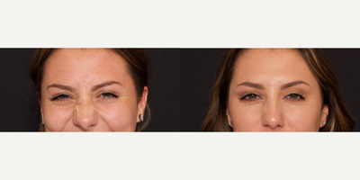 Woman treated with Dysport - Woman treated with Dysport